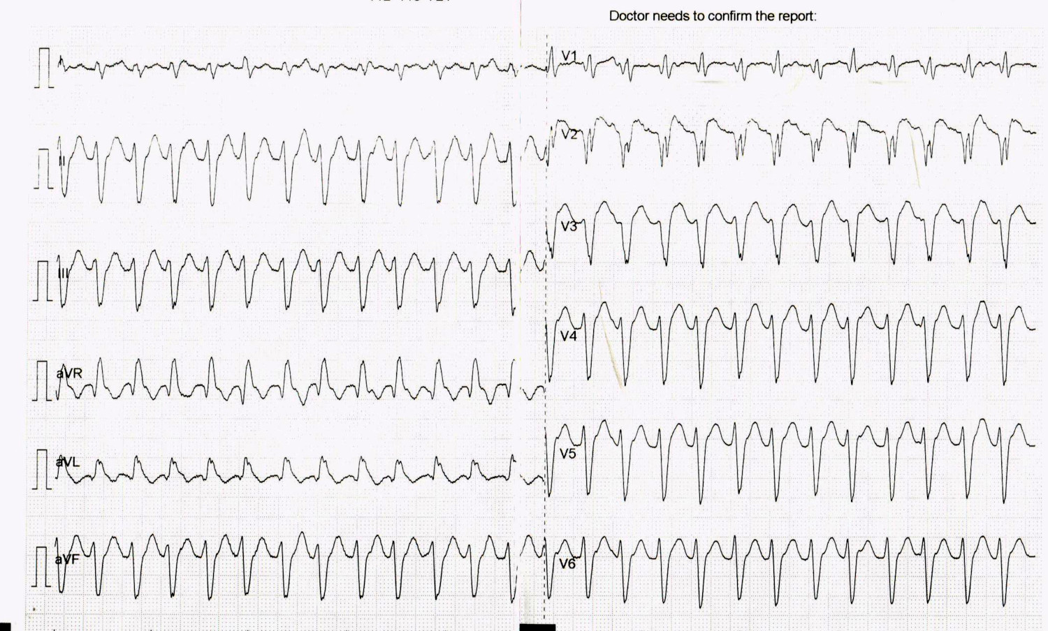 kumar old mi sustained VT_001.jpg
